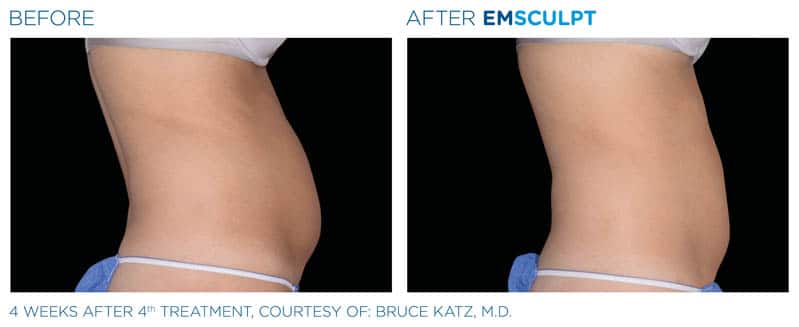 Mit Emsculpt Das Fett An Armen Und Beinen Loswerden Clinique Delc